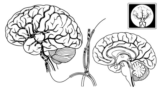 Cerebral Artery Angiogram Interventional Radiology Vector Diagram