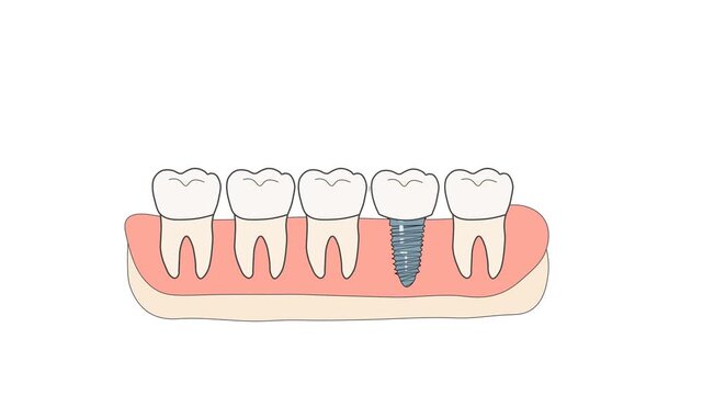 Flat Medical Animation Showing A Dental Implant Placed In A Missing Tooth Space And Completed With A Crown, Illustrating Implant Surgery, Restoration, Prosthetic Dentistry, And Oral Healthcare.