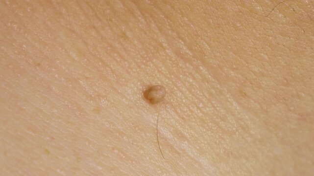 Dermatology body diseases papilloma or melanoma. Mole big wart on skin. Oncology malignant tumor