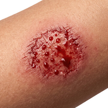 Fresh painful abrasion burn wound with blood on human skin