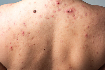 Naklejka premium Skin problem with infected pore. Skin problem and visible pus. Dermatology evaluates skin problem condition. Human skin problem.
