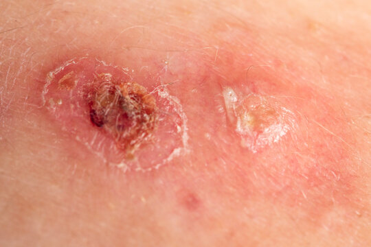 Skin abscess with purulent pus. Abscess and boil inflammation. Infected skin for medical dermatology. Open lesion with drainage.