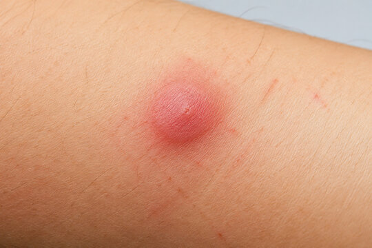 Red swollen mosquito bite on forearm skin, insect bite irritation and allergy
