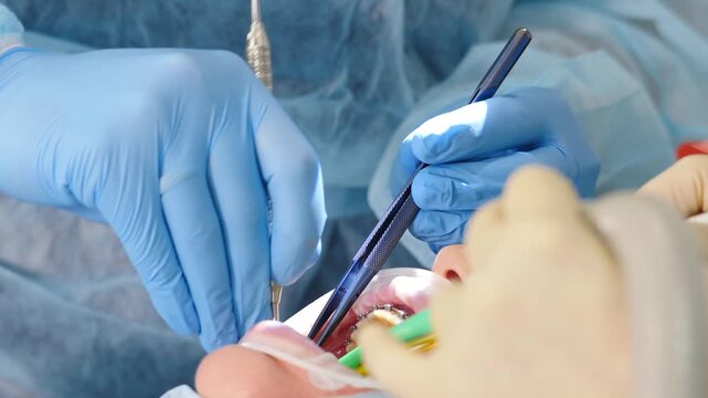 Dental surgeon performing precise surgical manipulation in patient mouth with braces. Professional preparatory step before dental implant placement. Modern oral healthcare and surgical treatment. 4k