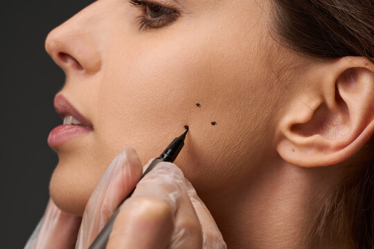 Bruxism treatment facial marking with pen. Doctor hands in gloves drawing dots on female cheek for masseter muscle botulinum toxin injection