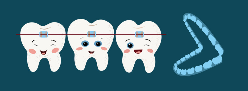 Dental braces and transparent aligners on teeth, professional dental care, teeth alignment, orthodontic correction, blue background.
