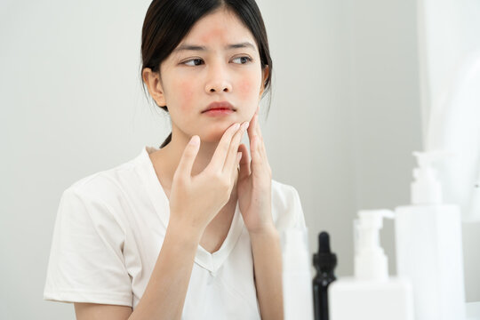 Woman worried about face Dermatology, rosacea dermatitis, allergic steroids, sensitive skin, red face from sunburn, acne, dry skin, large pores ,rash face, dull, freckles, wrinkle, skin problem,