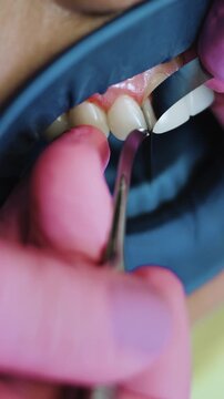 Vertical shot of a dentist carefully removing excess composite from dental veneer margin