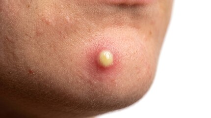 Fototapeta premium Macro shot of large inflamed purulent pimple with yellow pus on human chin