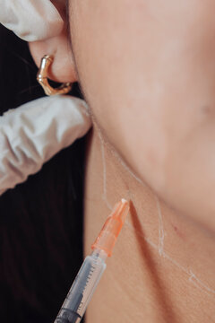 Female patient receiving mesotherapy injections at an aesthetic clinic below the jawline for double chin reduction and contouring
