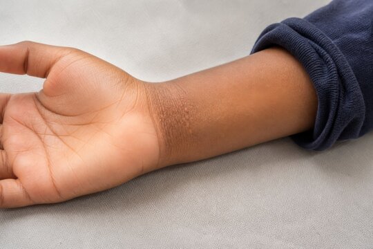 Child wrist with sweat rash papules on dark skin