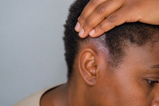 Woman showing psoriasis plaque on scalp behind ear