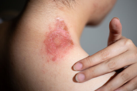 Medical close up of hand touching an itchy allergic irritated skin with a redness  insect bite rash on the neck.  