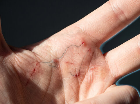 Scabies Infestation with Burrow Tracks and Excoriated Papules in Adult Finger Web Space, Parasitic Skin Disease Macro Photograph
