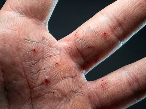 Scabies Infestation with Burrow Tracks and Excoriated Papules in Adult Finger Web Space, Parasitic Skin Disease Macro Photograph