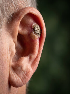 Squamous Cell Carcinoma Firm Crusted Keratotic Nodule on Older Adult Ear Rim, Skin Cancer Dermatology Reference Photograph