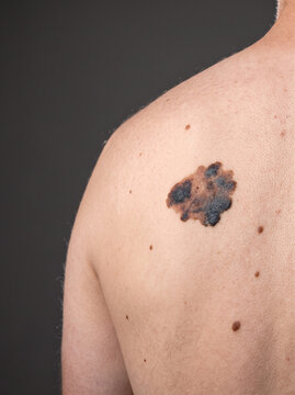 Malignant Melanoma Irregular Asymmetric Dark Mole with Uneven Borders on Adult Back, Skin Cancer ABCDE Medical Photograph
