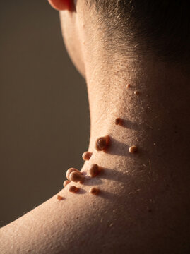 Multiple Skin Tags Acrochordons Hanging on Adult Neck Skin Fold, Benign Fibroepithelial Growths Macro Medical Photograph