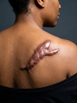 Keloid Scar Thick Raised Overgrown Fibrous Tissue on Adult Shoulder, Abnormal Wound Healing Dermatology Close Up Photograph