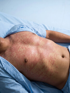 Morbilliform Drug Eruption Widespread Symmetrical Red Macular Rash on Adult Trunk, Medication Reaction Medical Photograph