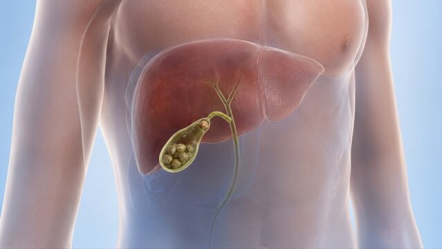 Gallstones shown inside semi-transparent upper torso with multiple calculi in the gallbladder in premium clinical CGI