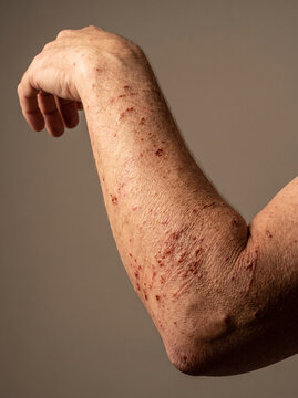 Dermatitis Herpetiformis Intensely Itchy Grouped Vesicles and Excoriations on Adult Elbow, Coeliac Skin Disease Photograph