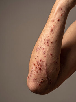 Dermatitis Herpetiformis Intensely Itchy Grouped Vesicles and Excoriations on Adult Elbow, Coeliac Skin Disease Photograph