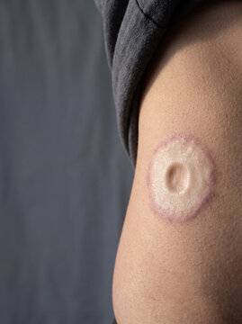 Morphea Localised Scleroderma Ivory Firm Sclerotic Patch with Lilac Ring on Adult Torso, Skin Fibrosis Medical Reference Image