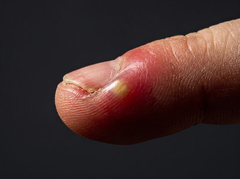 Acute Paronychia Red Swollen Painful Nail Fold with Pus on Adult Finger, Nail Infection Close Up Medical Photograph