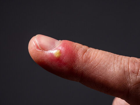 Acute Paronychia Red Swollen Painful Nail Fold with Pus on Adult Finger, Nail Infection Close Up Medical Photograph
