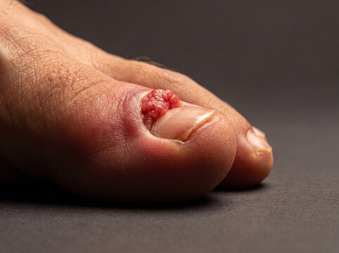 Ingrown Toenail with Inflamed Overgrown Nail Fold and Granulation Tissue on Adult Toe, Podiatry Medical Reference Image