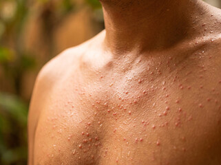Naklejka premium Miliaria Rubra Heat Rash Tiny Red Prickly Bumps on Adult Chest and Neck, Blocked Sweat Duct Skin Disease Macro Image