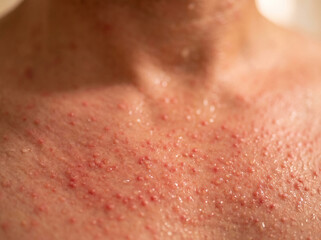 Fototapeta premium Miliaria Rubra Heat Rash Tiny Red Prickly Bumps on Adult Chest and Neck, Blocked Sweat Duct Skin Disease Macro Image