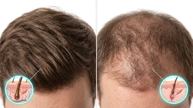Hair Loss Male Pattern Baldness Hair Thinning, medical illustration comparing healthy hair growth with male scalp hair loss and baldness