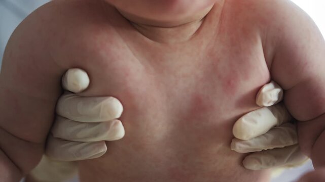 Medical professional examines baby skin for rash, focusing on redness and inflammation. The exam highlights pediatric care, health monitoring, and early diagnosis for child wellbeing.