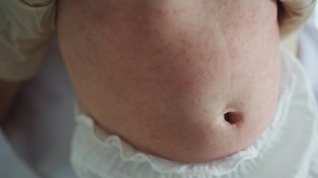 A close-up view of a child's skin showing a red, inflamed rash with visible texture and irritation. Baby Skin Rash Examination. Pediatric care ensures early diagnosis and child wellbeing.