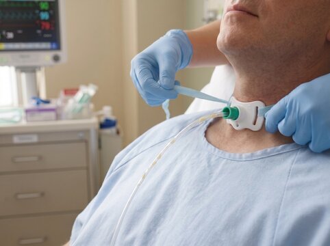 Close-up view of an ICU nurse's hands in sterile gloves suctioning and replacing a tracheostomy inner cannula tie