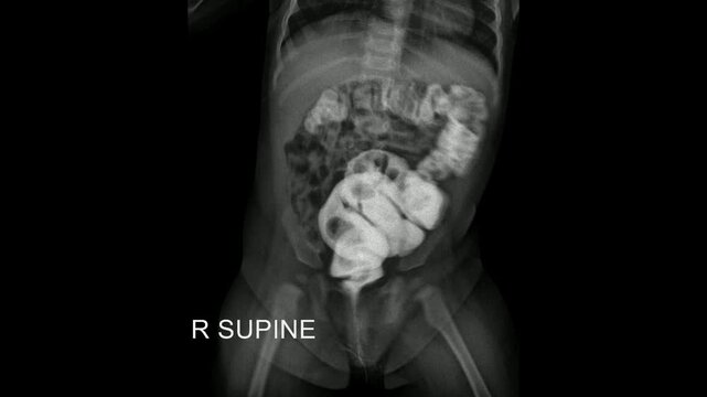 Supine abdominal radiograph during pediatric contrast enema examination demonstrating contrast opacification of the colon.
