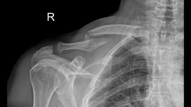 Right Humerus and Shoulder Joint Clavicle Fracture video