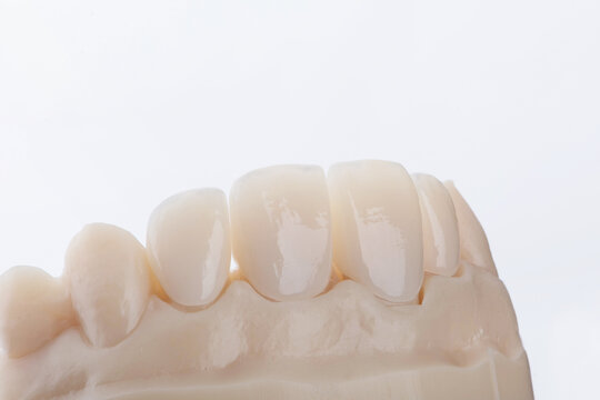 High-quality four dental crowns made of zirconium for fixation to the frontal teeth of upper jaw.