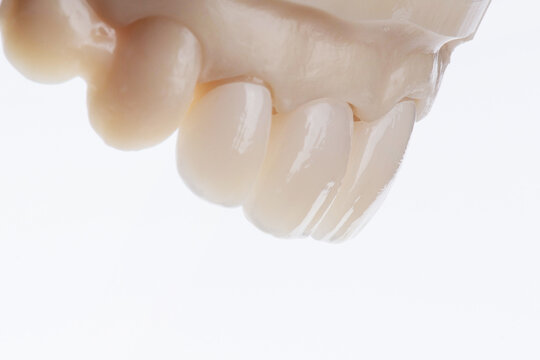High-quality four dental crowns made of zirconium for fixation to the frontal teeth of upper jaw.