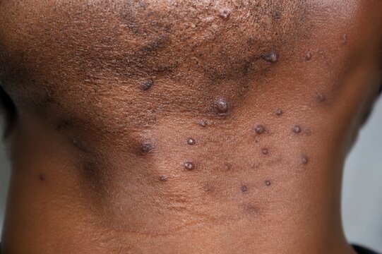 Pseudofolliculitis barbae and razor bumps under the jawline

