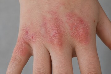 Fototapeta premium Active Eczema-Like Dermatitis on Back of Hand