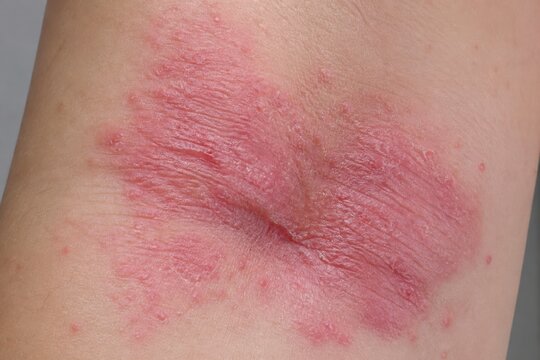 Active Flexural Eczema-Like Dermatitis on Inner Elbow