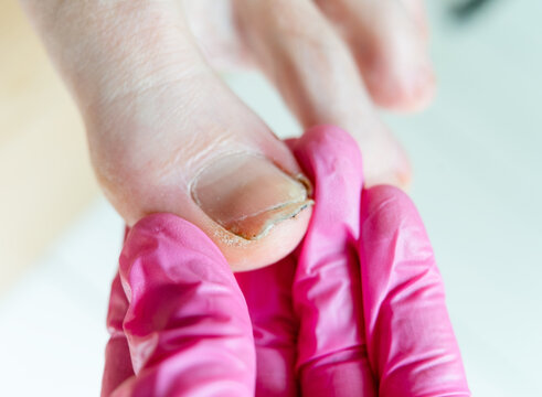 Closeup from above of a doctor consulting a patient with nail damage and damaged nail. A concerned physician examines injured nail for footwear injury and nail trauma in a sterile podiatry clinic.