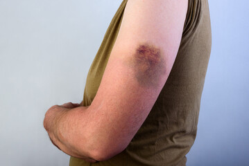 Fototapeta premium Stain bruise wound on arm of injured woman an accident fell down. The concept of a blood hematoma.