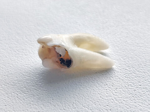 Extracted human molar tooth with visible decay and cavity on a white textured surface, close up dental specimen.
