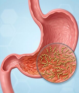 Stomach with Helicobacter Pylori Colonization: stomach lining with numerous small, spiral-shaped H. Pylori bacteria densely colonized on the surface mucosa, causing irritation	
