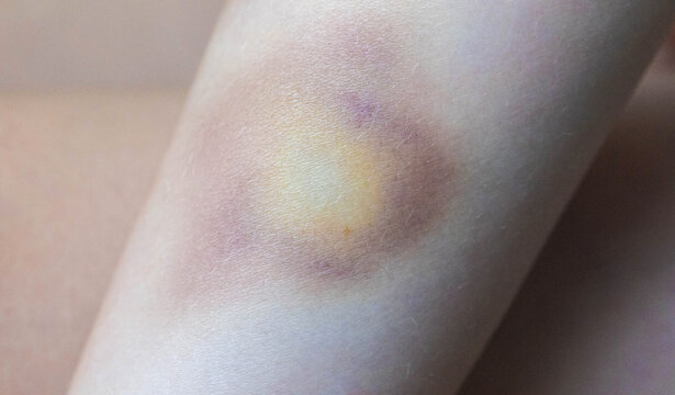 Close up view of colorful bruise on skin of child arm revealing stages of healing process with purple, yellow, and red discoloration due to impact