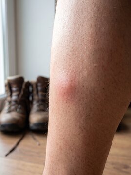 Swollen Bug Bite On Leg After A Day Outdoors